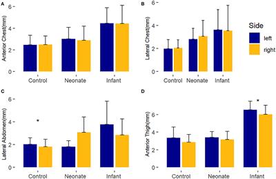 Validation of Point-of-Care Ultrasound to Measure Perioperative Edema in Infants With Congenital Heart Disease